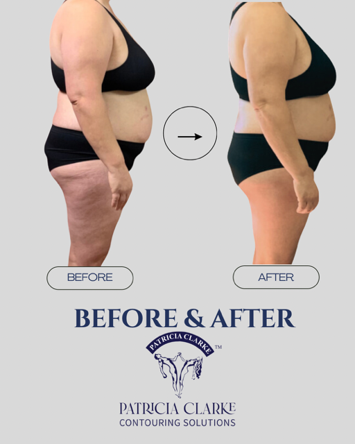 Cellulite Reduction Program