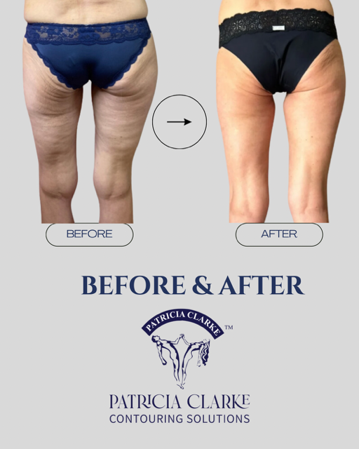 Body Contouring Treatment