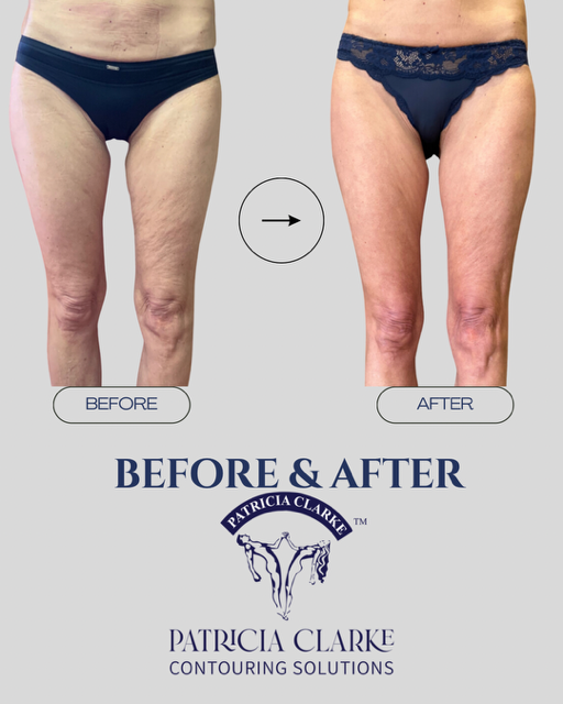 Skin Tightening Therapy